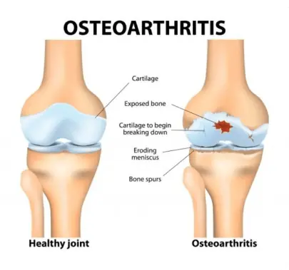Osteoarthritis