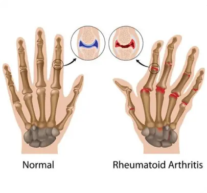 Rheumatoid Arthritis