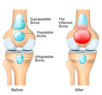 Brusitis and Tendinitis